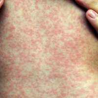 2 more Utahns diagnosed with measles, bringing state total to 5